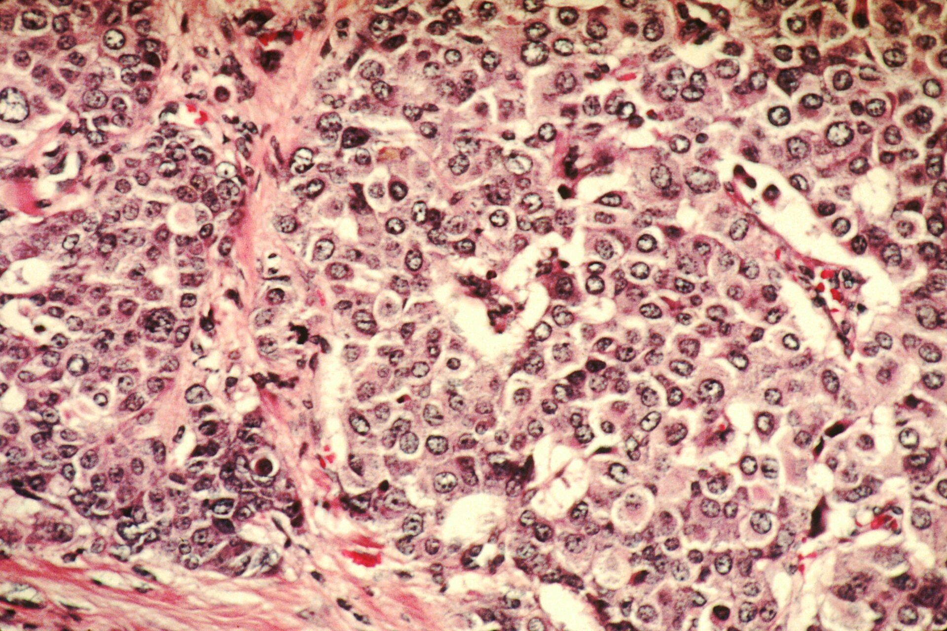 Células cancerígenas. Wikimedia Commons
