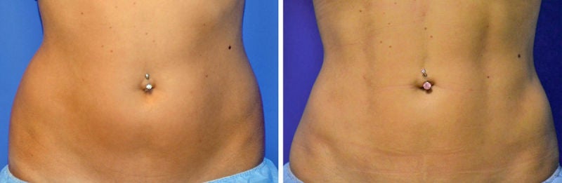 Vista frontal preoperatoria (izquierda) en comparación con una fotografía obtenida 6 meses después de la operación de una paciente con grabado de línea vertical y líneas de cadera definidas (derecha). Foto: Journal of the American Society of Plastic Surgeons