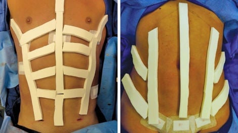 (Izquierda) Vista intraoperatoria con TopiFoam colocado para un paciente masculino. (Derecha) Vista intraoperatoria con TopiFoam colocado para una paciente. Foto: Journal of the American Society of Plastic Surgeons