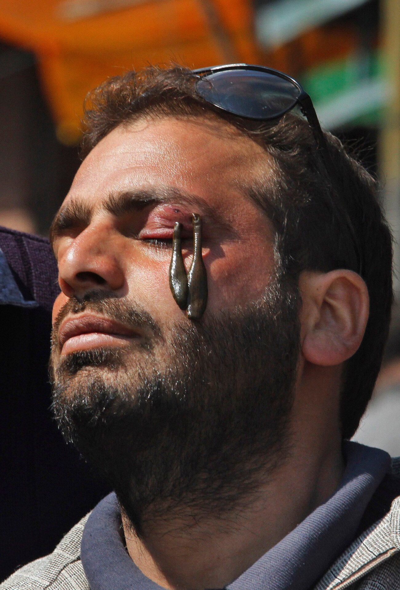 Image: Terapia de sanguijuelas