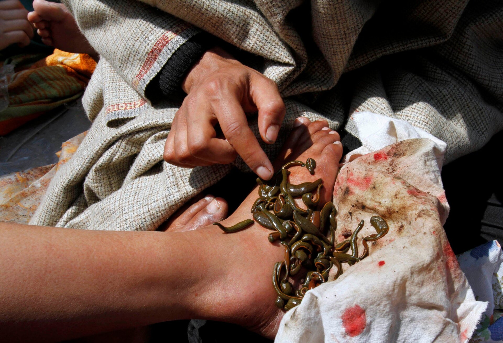 Image: Terapia de sanguijuelas en India