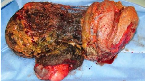 El “gemelo” de la chica. Foto: Kumar, et al (BMJ Case Reports)