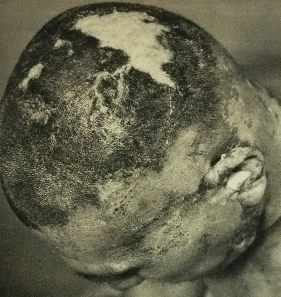 Image: La cabeza de uno de los miembros de la tripulación el 7 de abril de 1954, con quemaduras y decoloración general de la piel