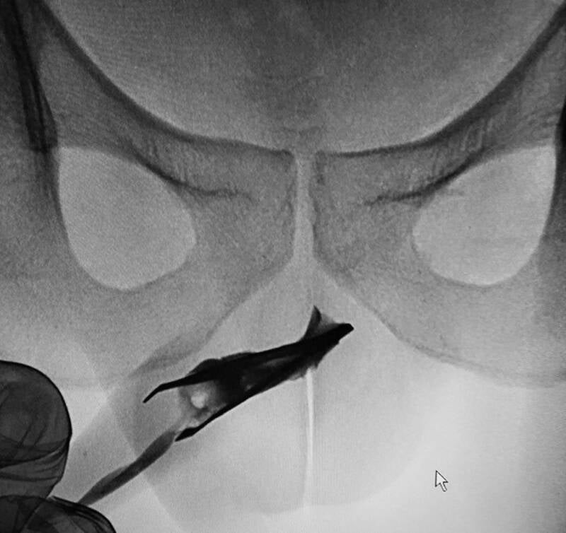 Image: Radiografía que muestra las pinzas en la uretra