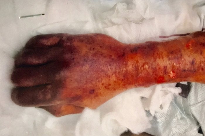 Image: El brazo del paciente al cuarto día