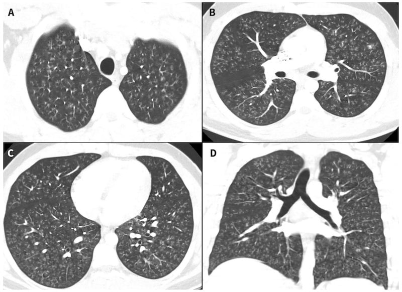 La tomografía computarizada del pecho del adolescente muestran varios nódulos asociados a la bronquiolitis constrictiva.