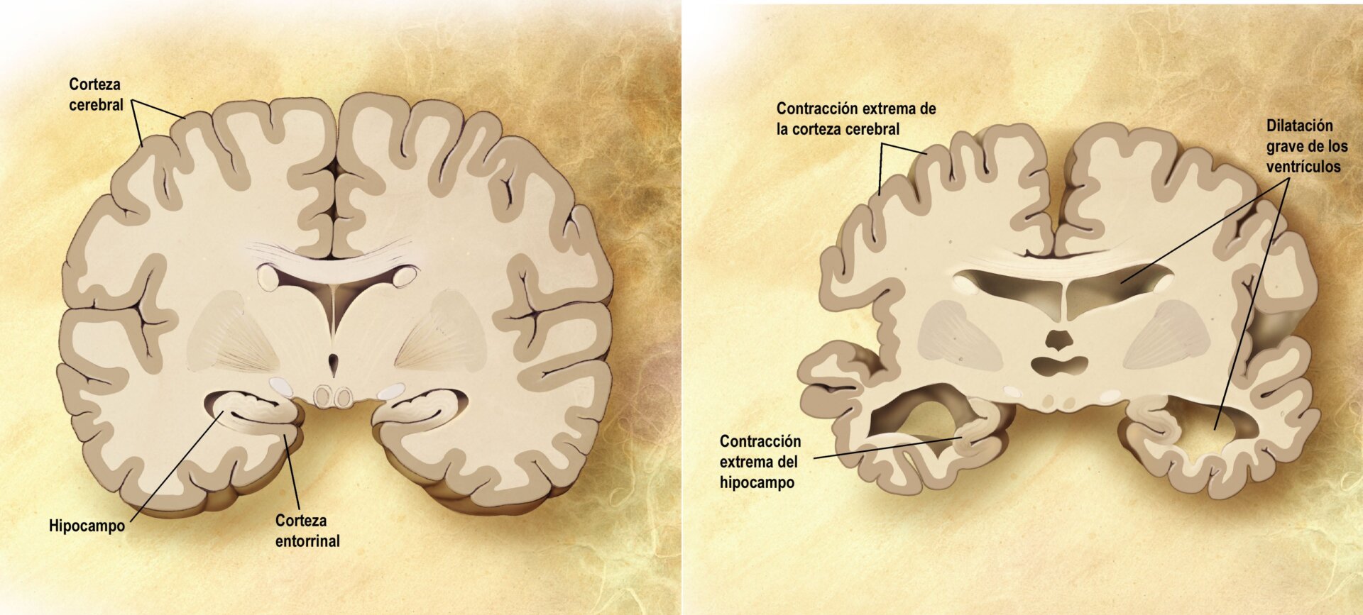 Image: Esquema de un corte frontal de dos cerebros. El de la izquierda es un cerebro sano y el de la derecha uno que padece la enfermedad de Alzheimer