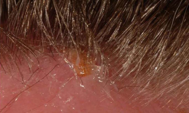 Image: La frente de la paciente