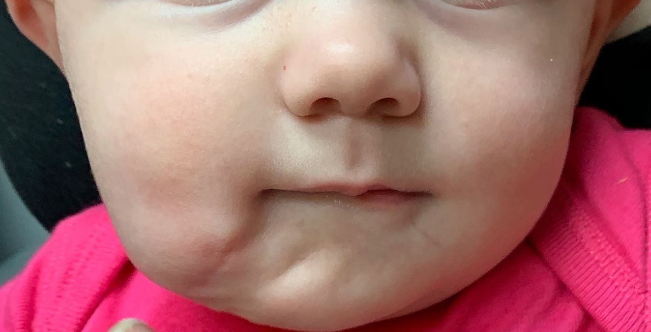 Image: La pequeña después de la cirugía