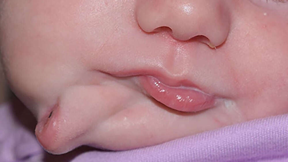 Image: Imagen con la segunda boca de la niña