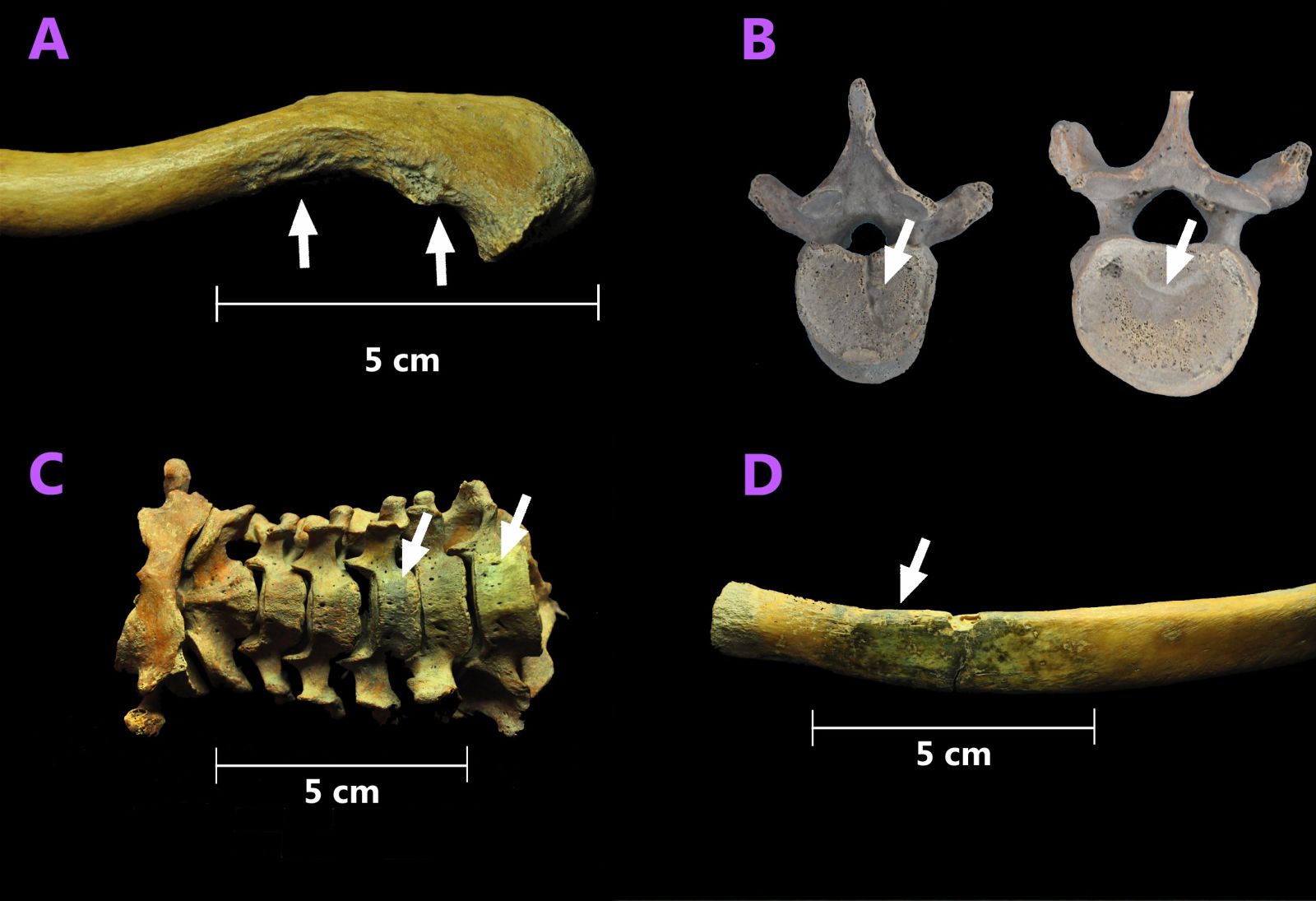 Image: Daño articular y óseo encontrado en los restos esqueléticos: (A) desgaste óseo extenso, (B) signos de hernia en una vértebra, (C y D) coloración verdosa como evidencia de una bala de cobre.