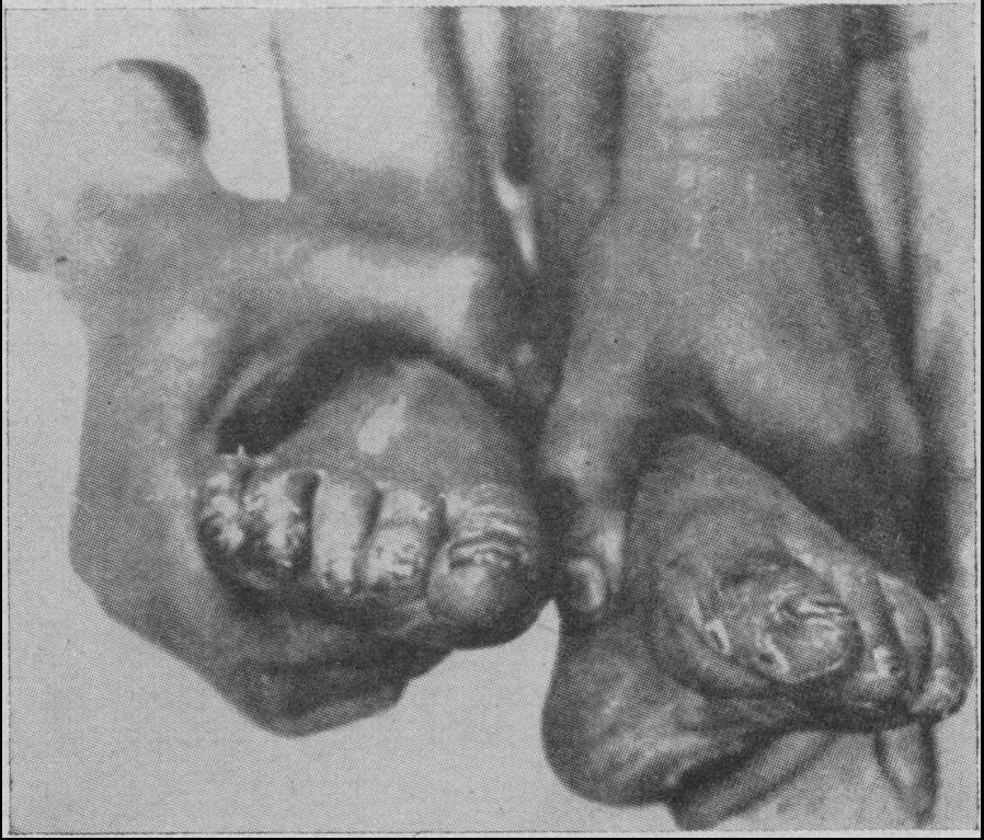 Ergotismo con gangrena.