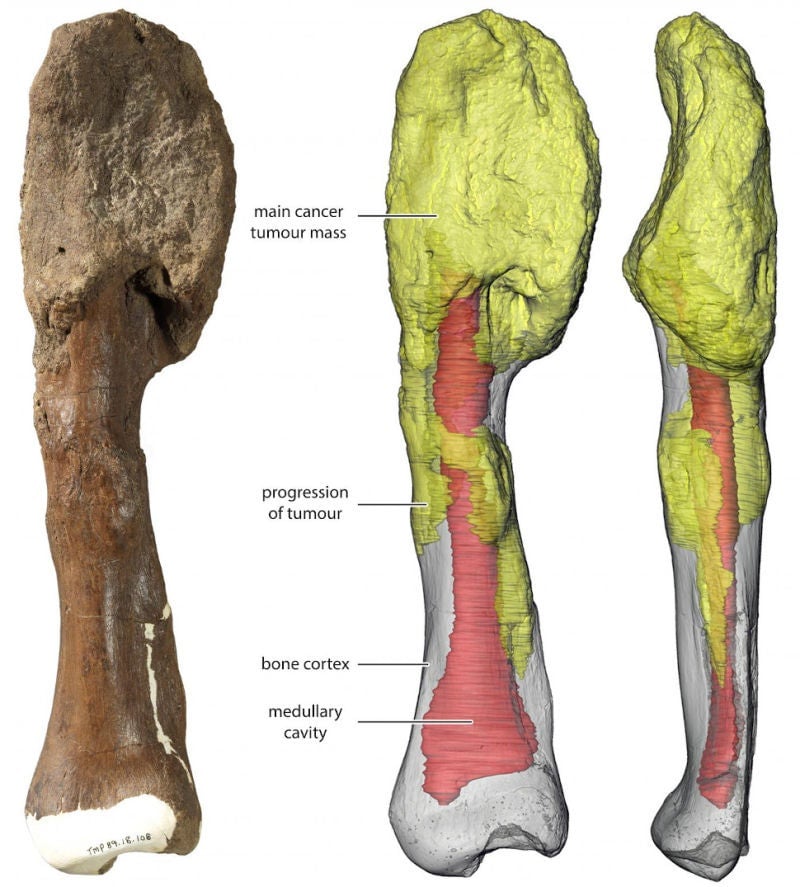 La masa tumoral principal está en la parte superior del hueso y se puede ver en la reconstrucción 3D en amarillo; rojo gris es el hueso normal y rojo denota la cavidad medular.