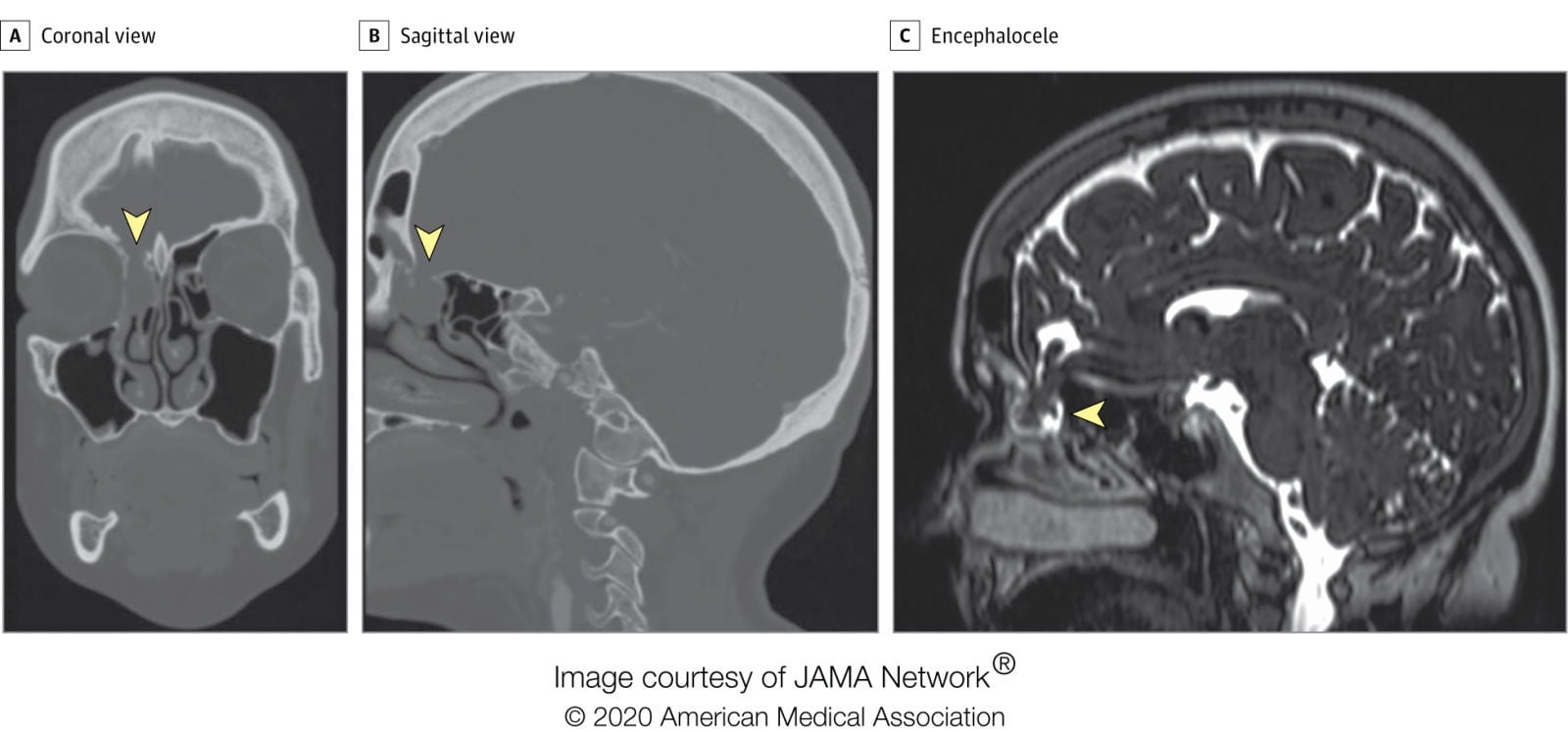 Una tomografía computarizada del cerebro de la mujer tomada en 2017 reveló su raro defecto congénito, pero no se notó hasta después de que una prueba de frotis nasal para el covid-19 probablemente lo dañó y provocó la fuga de líquido cefalorraquídeo.