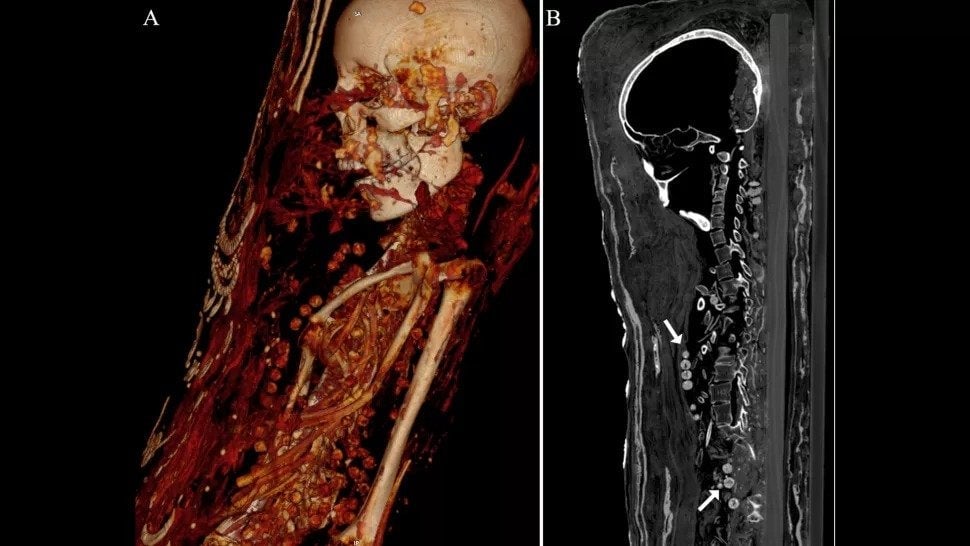 La tomografía computarizada muestra el collar alrededor del cuello y el cuerpo de la mujer.