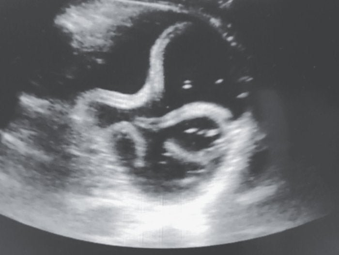 Image: Chaurasia & Bhoi, NEJM, 2020