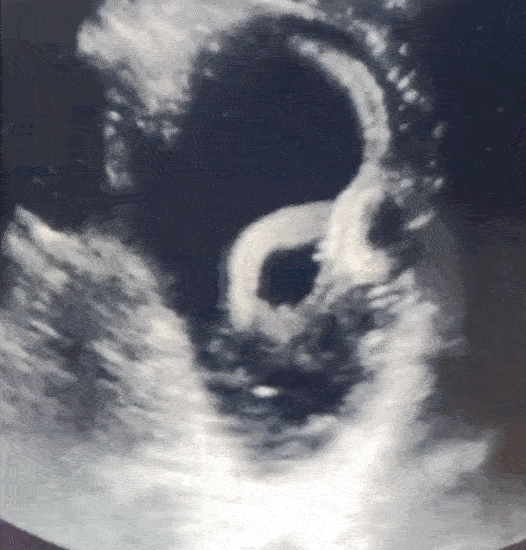 Gif: Chaurasia & Bhoi, NEJM, 2020