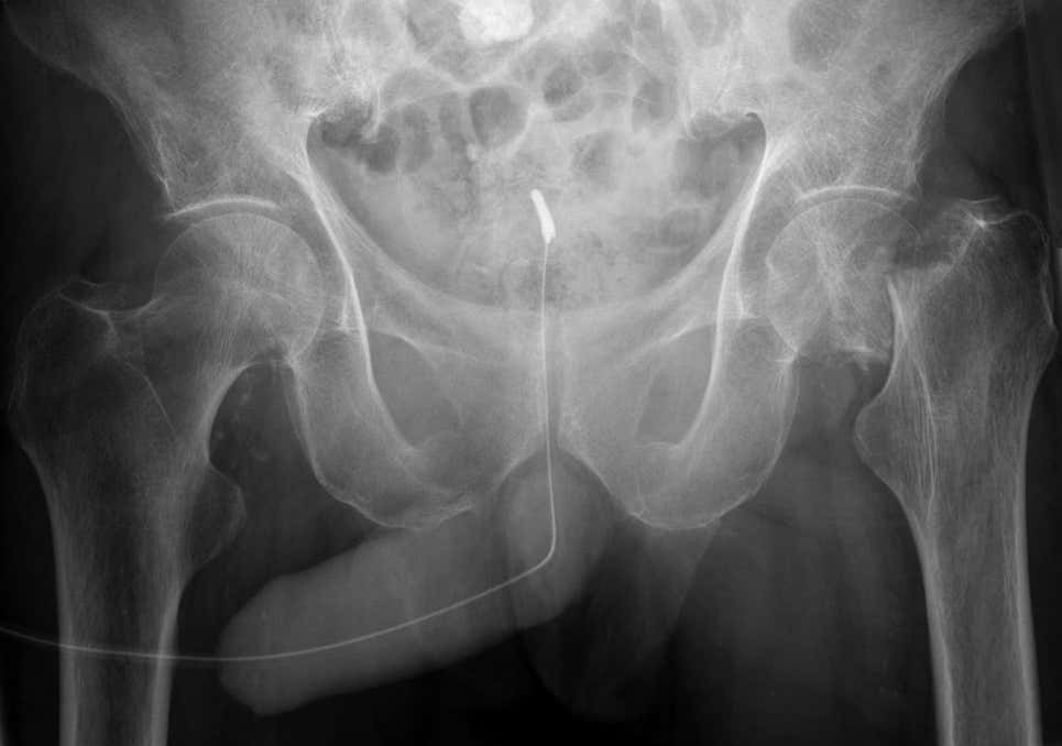 Radiografía de una fractura de pene
