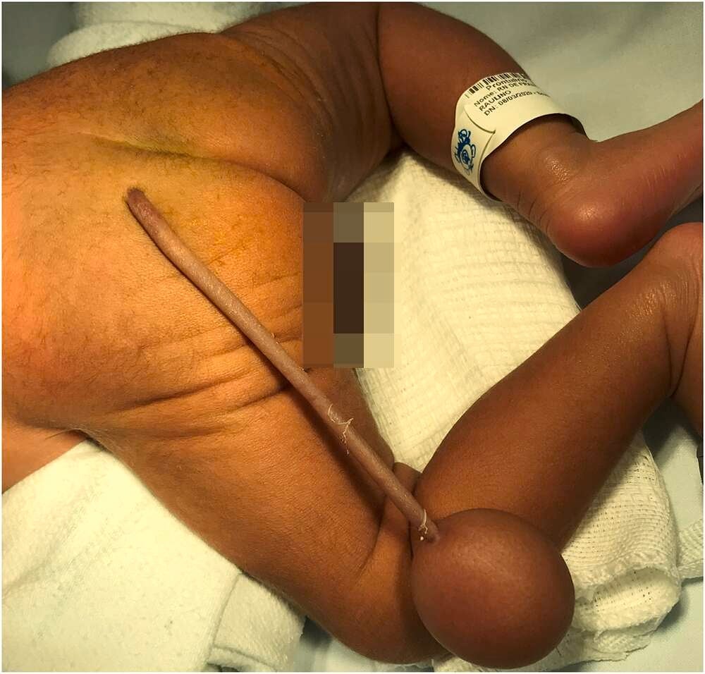 Image: Journal of Pediatric Surgery Case Reports, 2021 (CC by 4.0)