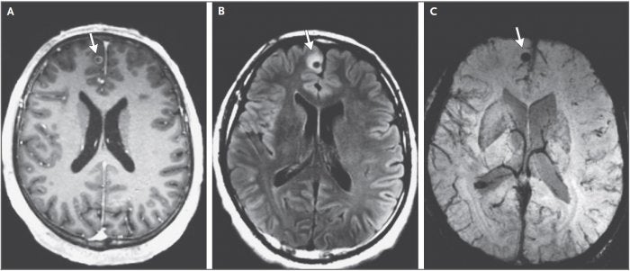 Imágenes por resonancia magnética que se centran en una de las tres lesiones cerebrales