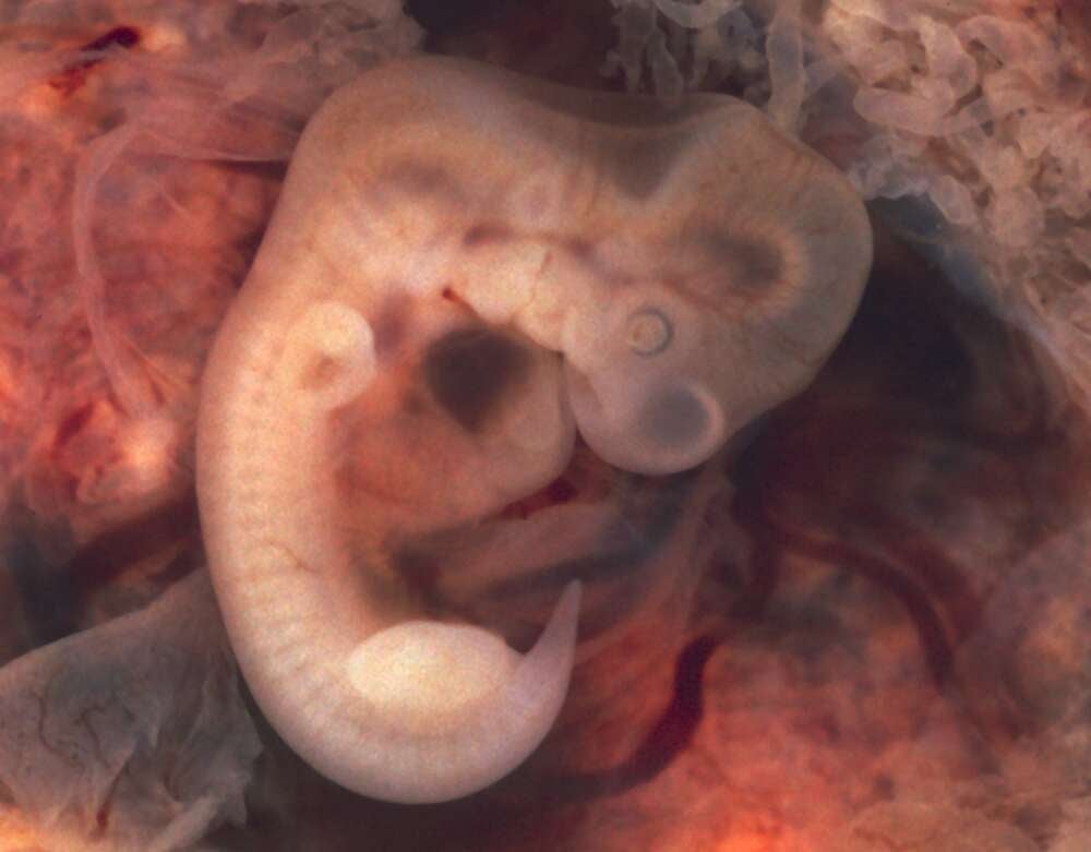 Image: Journal of Pediatric Surgery Case Reports, 2021 (CC by 4.0)