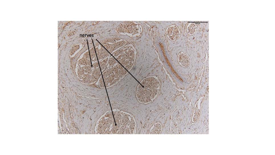 Nervios de gran tamaño en el clítoris de delfín.