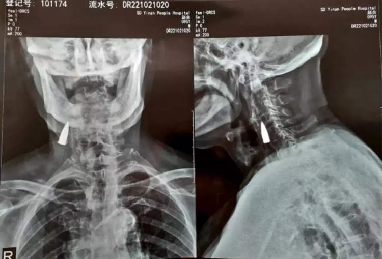 Radiografía que muestra la bala que ha vivido en el cuello de Zhao la mayor parte de su vida