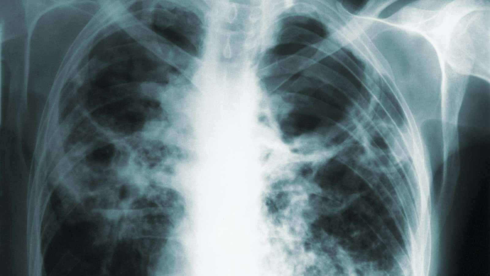 Una radiografía de tórax de un paciente con tuberculosis