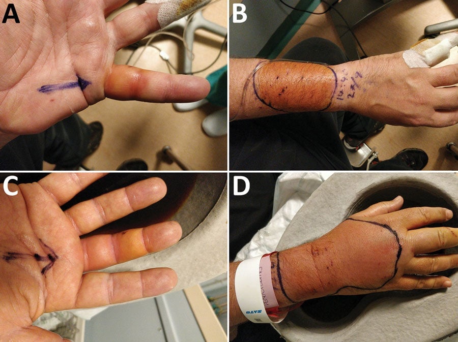 Al tratar de descubrir la causa exacta de la infección del hombre, los autores encontraron microbios dentro de sus heridas que se parecían