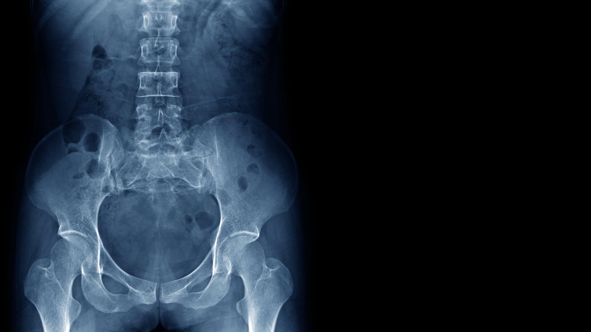 Una imagen de rayos x de una columna ble, cadera y pelvis humana sana.