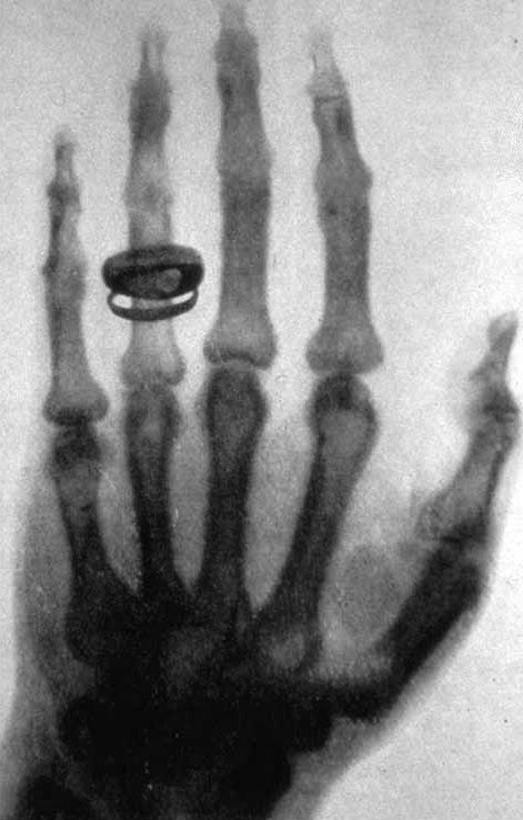 Una primera imagen de rayosX de una mano humana tomada por Wilhelm Röntgen.