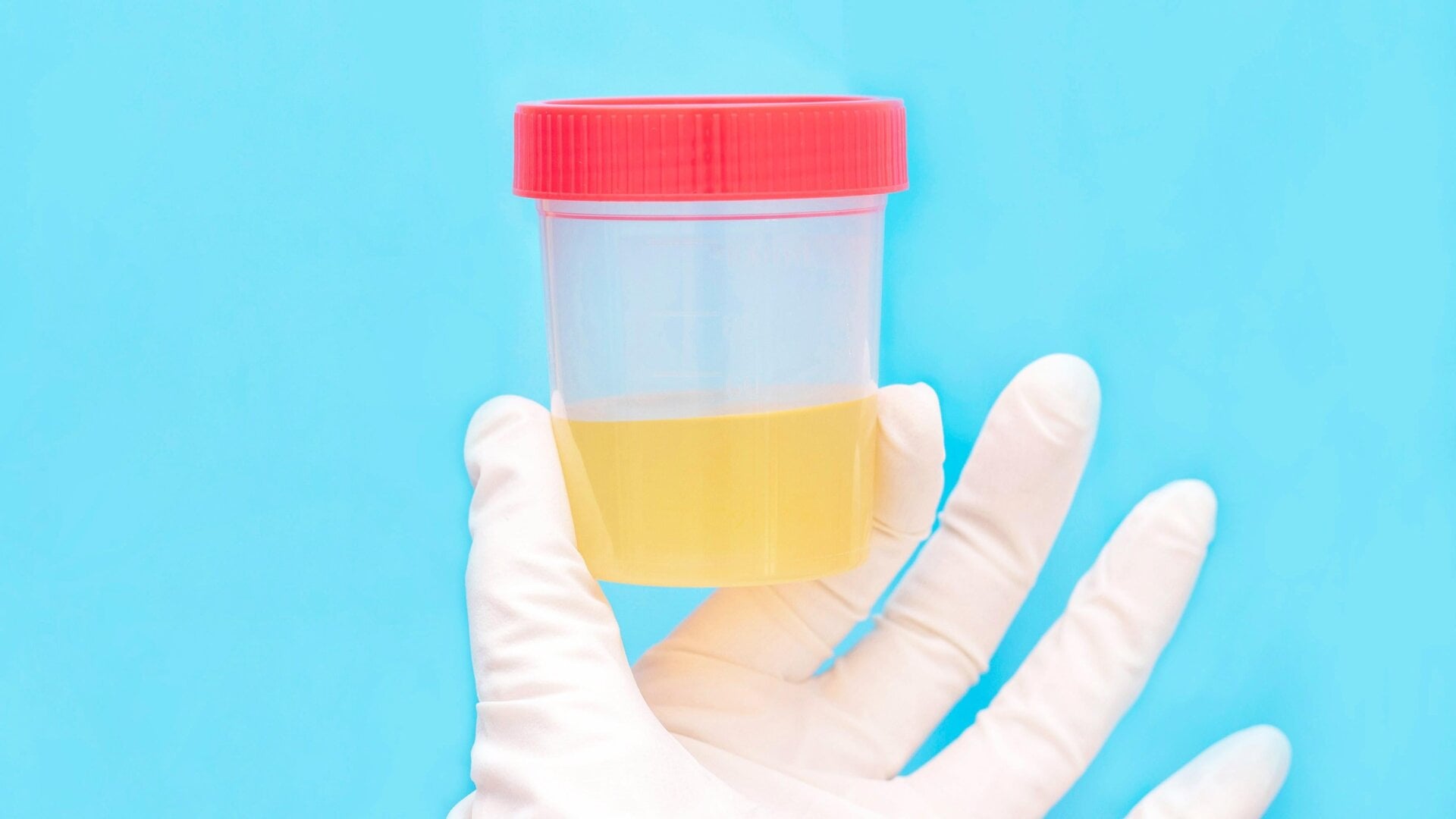 La prueba Simple 2 busca rastros genéticos de bacterias de clamidia y gonorrea recolectadas de muestras de orina o hisopos vaginales.