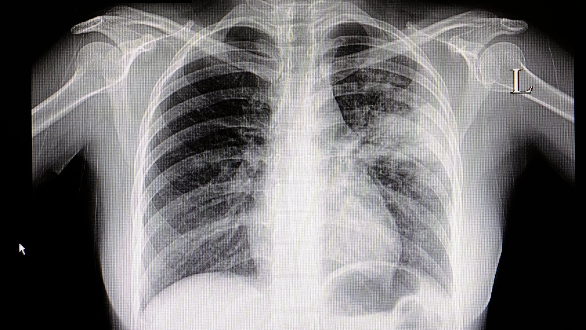 Una radiografía de tórax de una persona con neumonía en la porción media izquierda de su pulmón.
