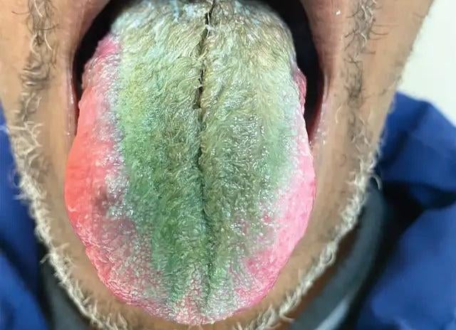 A diferencia de la mayoría de los casos, la lengua peluda del hombre se volvió de un extraño tono verde.