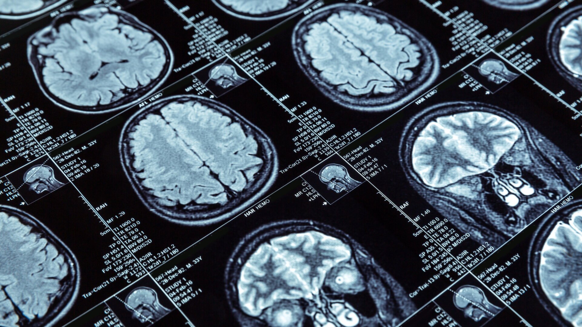 Exploraciones cerebrales por resonancia magnética.