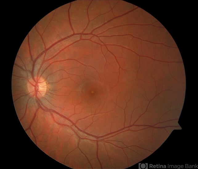 Imagen que muestra la retinopatía solar (el área oscurecida en el centro) de un hombre de 15 años que miraba directamente un eclipse solar. 