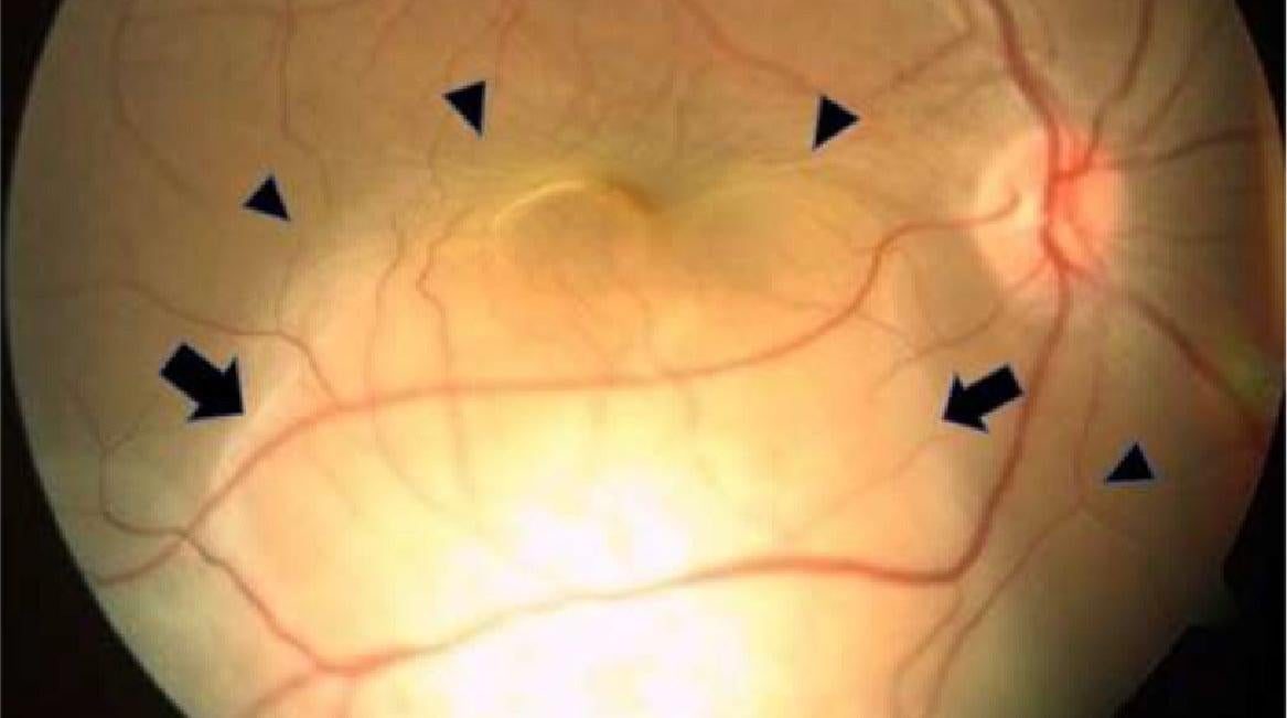 Las flechas negras apuntan a una gran masa subretiniana encontrada por los médicos de la mujer en su ojo derecho.