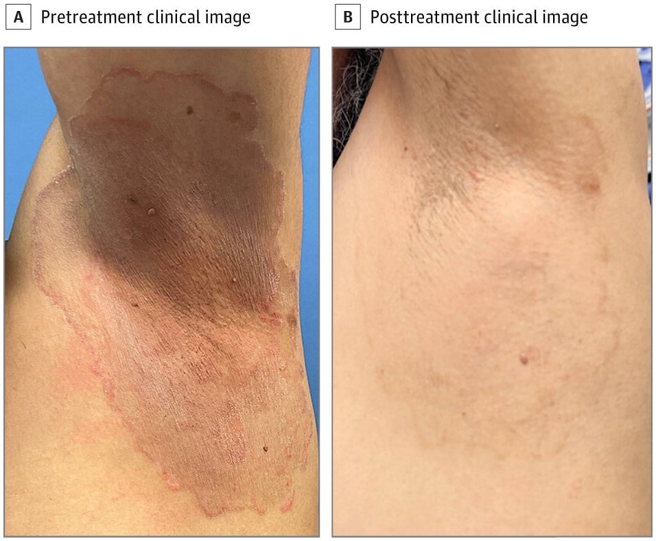 Imágenes de antes y después de un paciente con T. indotineae infección después de un tratamiento exitoso, del artículo más reciente del equipo de mayo.