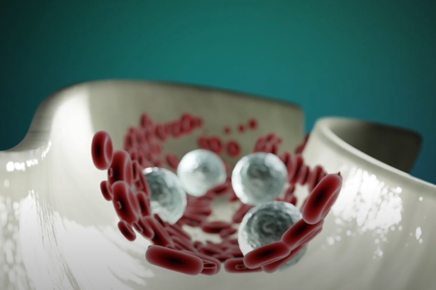 Acumulacion De Calcio