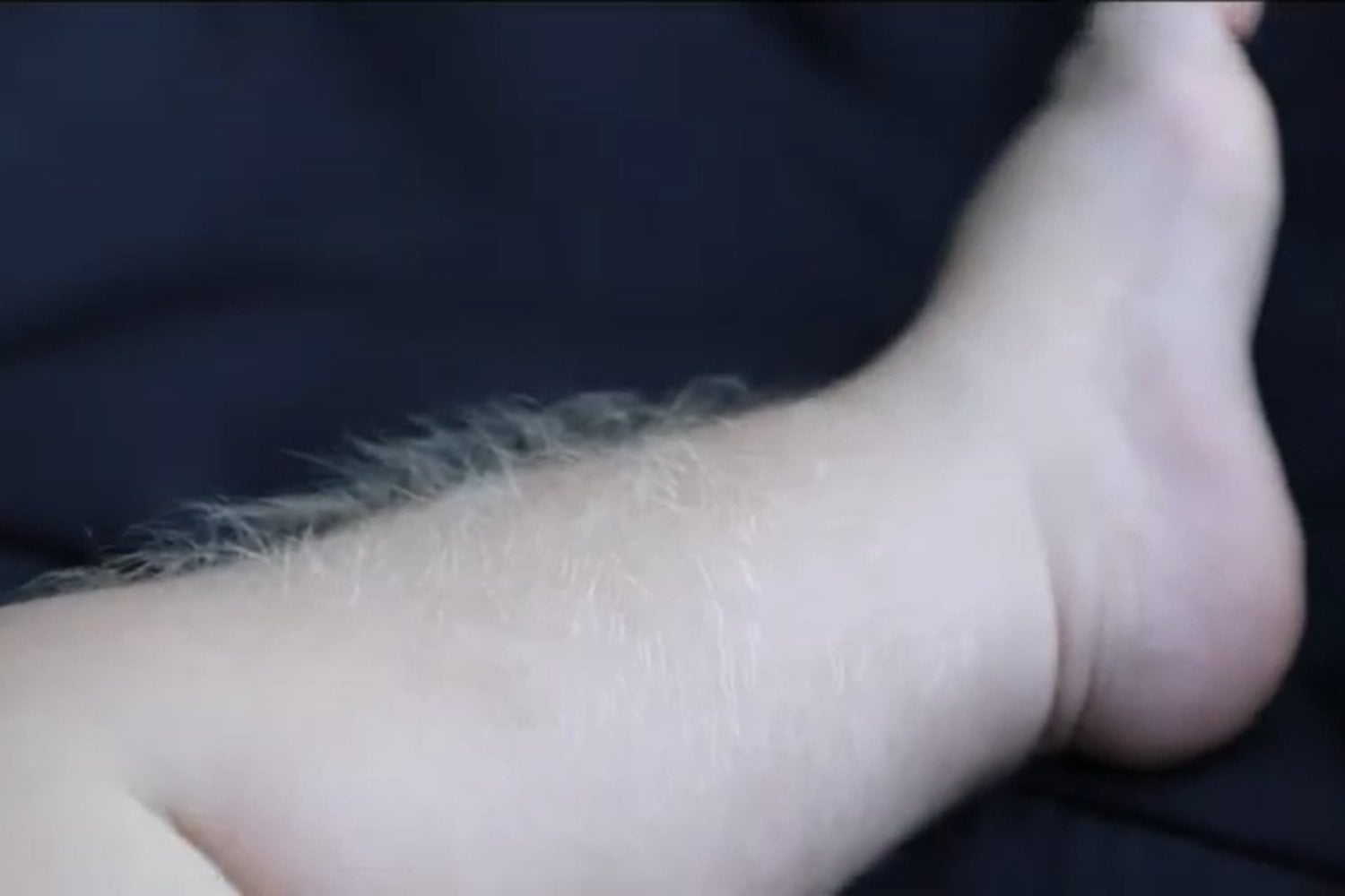 Síndrome del hombre lobo bebes