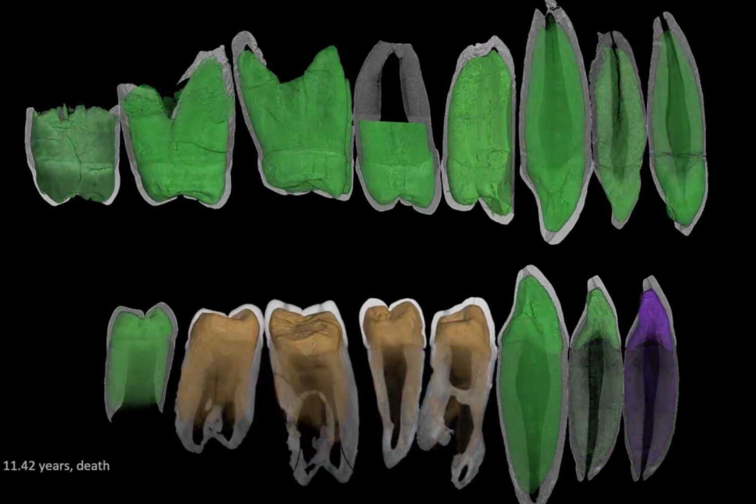 Fosil Dental Infancia Mas Larga