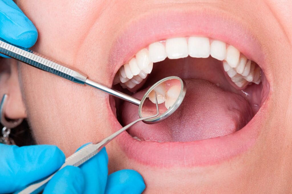 ¿El fin de las caries? Un material revolucionario podría regenerar dientes dañados