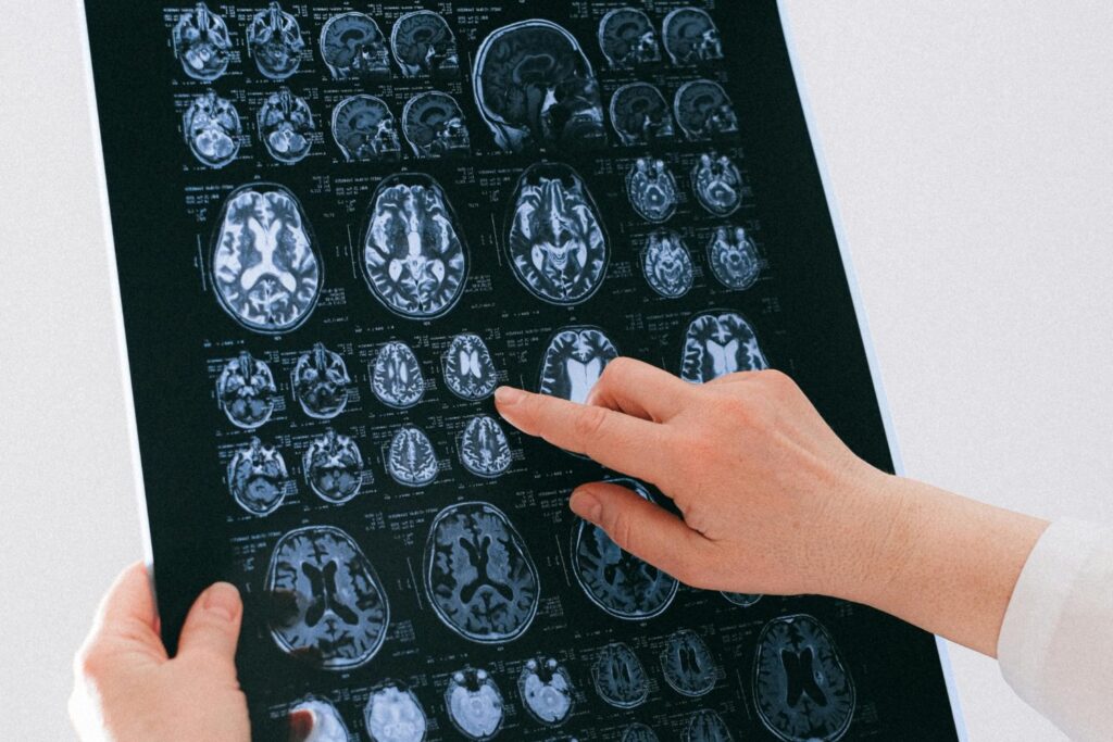 ¿Una nueva era para el párkinson? Lo que revelan dos ensayos clínicos que pocos esperaban.