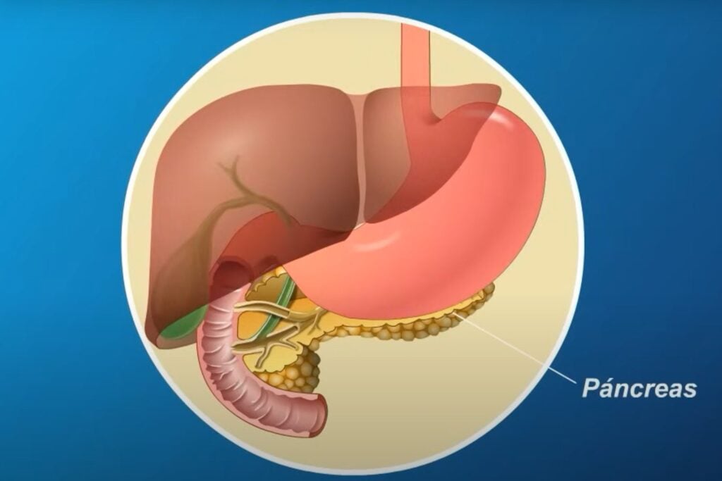 La extrema agresividad del cáncer de páncreas.