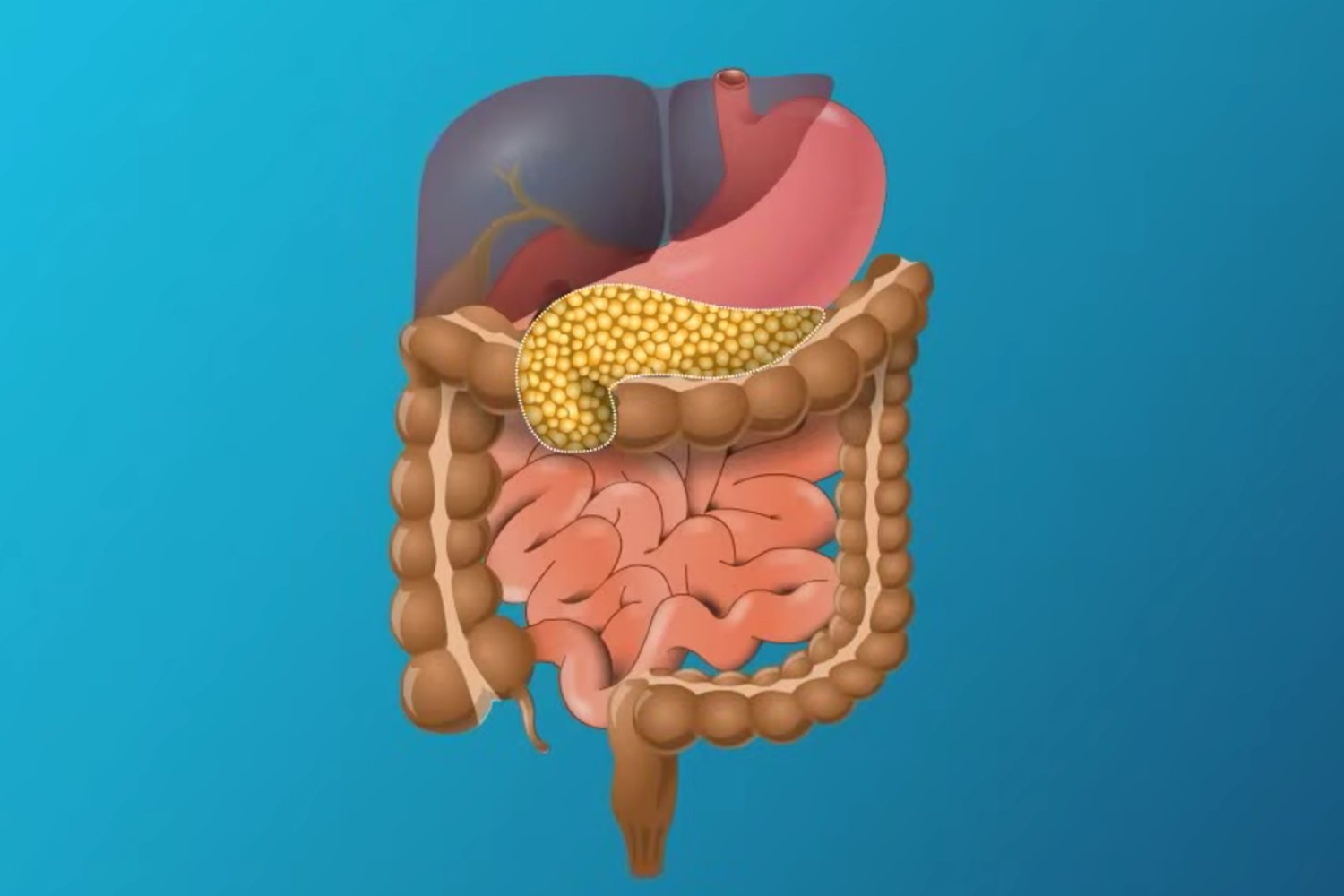 El cáncer de páncreas sigue siendo uno de los más mortales.