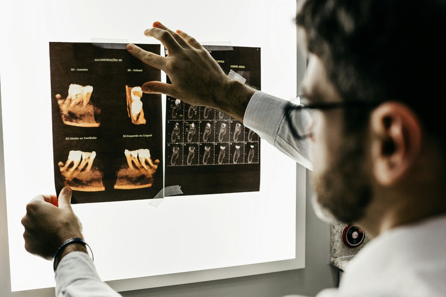 Uso Medico Muelas Del Juicio