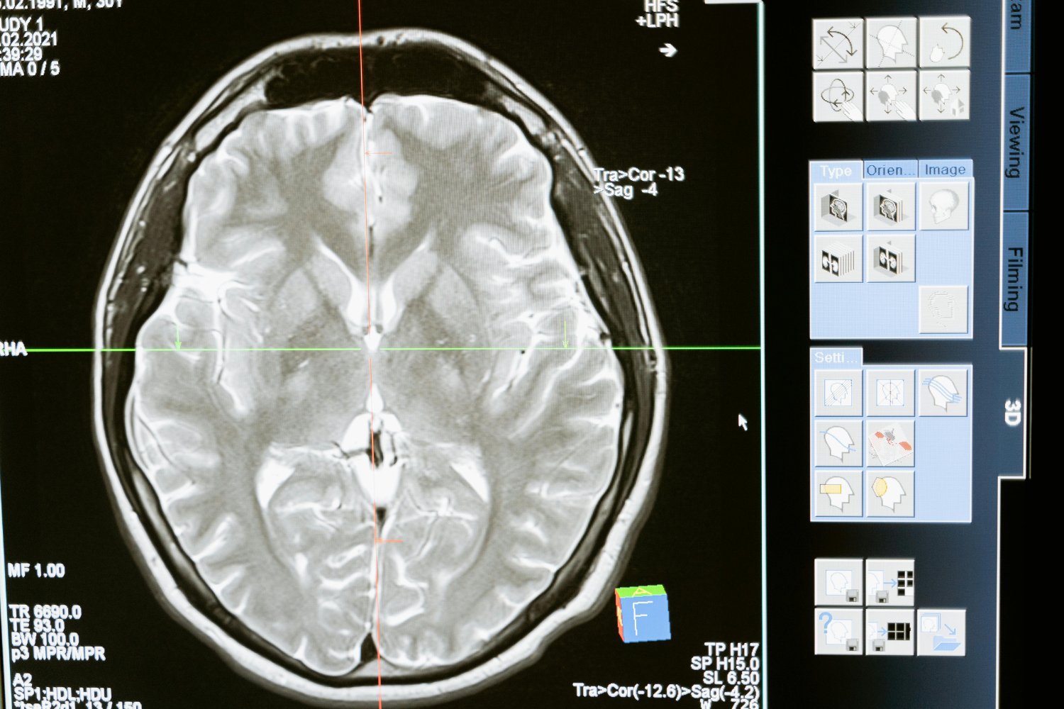 El sorprendente enigma del cerebro humano: ¿por qué empezó a encogerse?