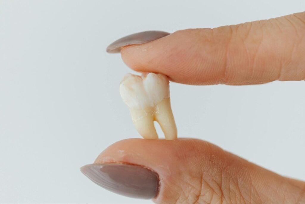 ¿Desecharlas o estudiarlas? El increíble potencial de una muela extraída