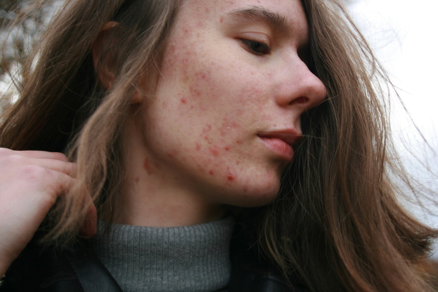 El Demodex Se Alimenta De La Grasa De Tu Piel Y Puede Causar Irritacion