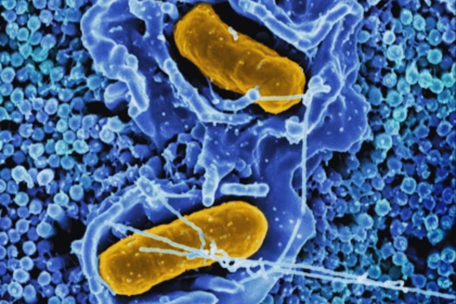 La fiebre tifoidea desafía a la medicina moderna: la alarmante expansión de bacterias resistentes a los antibióticos